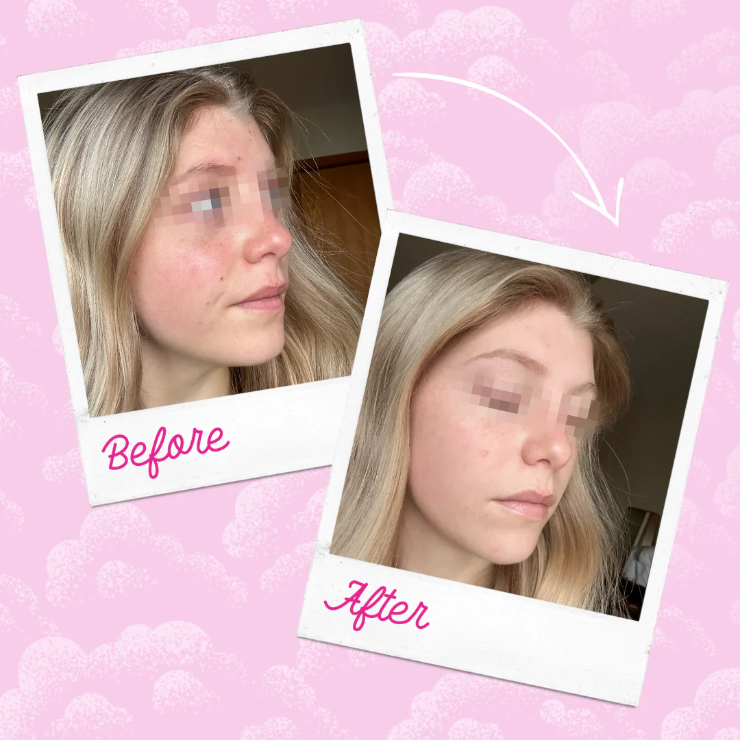 Silver Infused MakeUp Eraser PRO Acne Prone Skin - Image 8