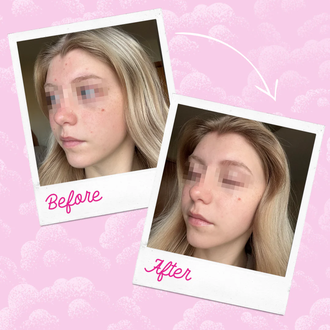 Silver Infused MakeUp Eraser PRO Acne Prone Skin - Image 9